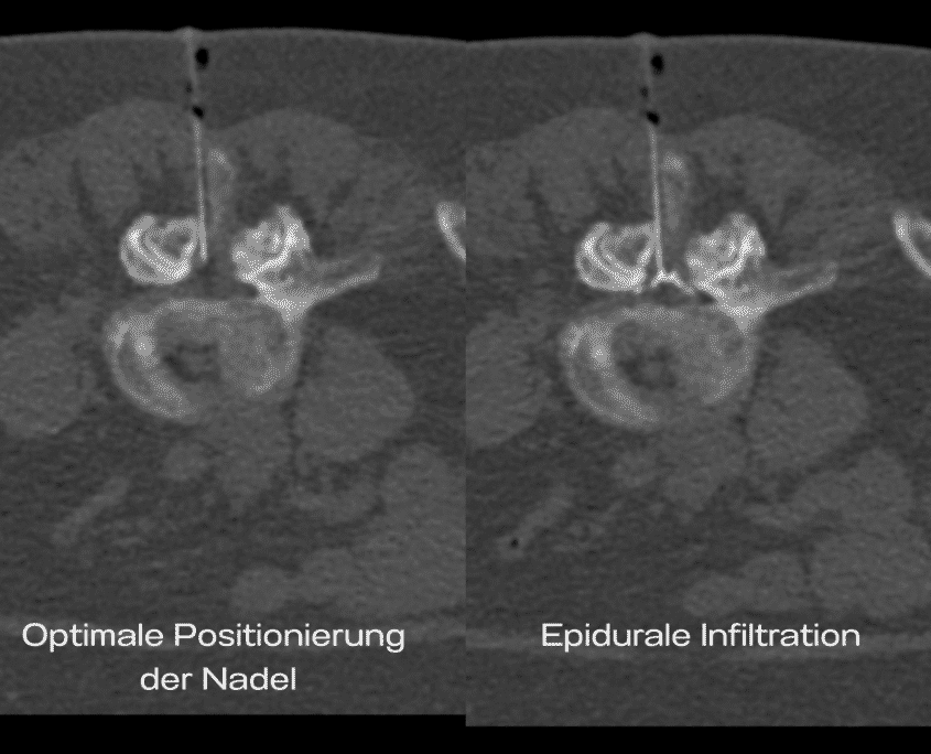 epidurale_infiltration Ansicht einer epiduralen Infiltration