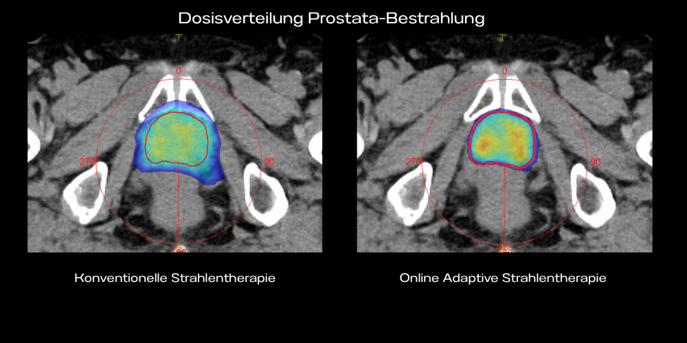 Strahlentherapie-dosisvergleich-konventionell-adaptiv Strahlungsdosierung im Vergleich der konvetionellen Bestrahlung gegenüber online adaptiver Bestrahlung